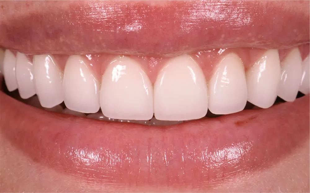 smile with veneers by Dr. Marashi