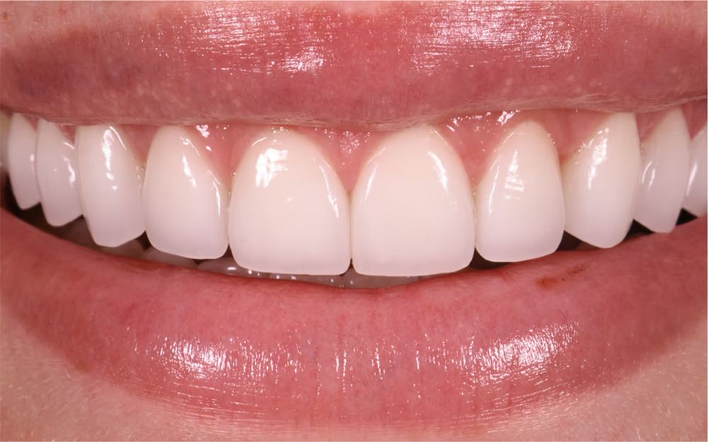 smile showing custom veneers by Dr. Marashi